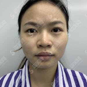 陕西三甲整形医院怎么样?西安中心医院整形科/西安中心医院医生/隆鼻加垫下巴的案例分享