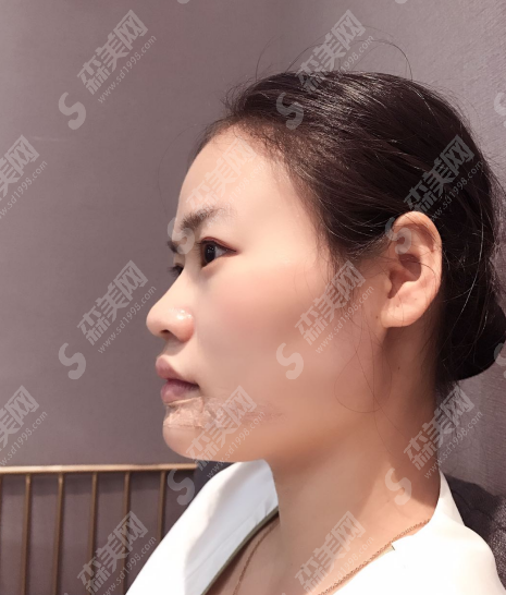 陕西三甲整形医院怎么样?西安中心医院整形科/西安中心医院医生/隆鼻加垫下巴的案例分享