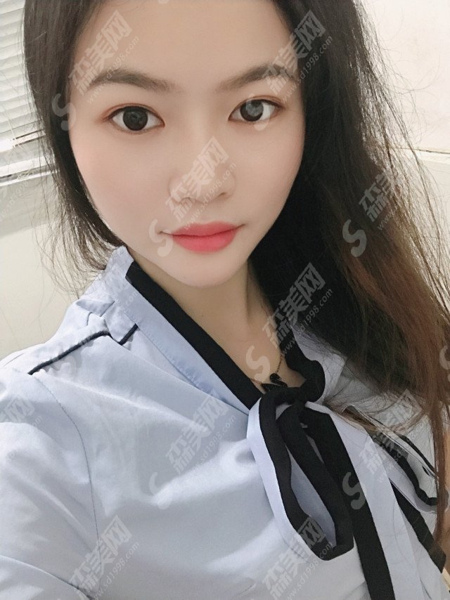 陕西三甲整形医院怎么样?西安中心医院整形科/西安中心医院医生/隆鼻加垫下巴的案例分享