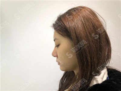 隆鼻整形价目表2021,假体隆鼻怎么样？内附假体隆鼻的1-7天真人恢复果图