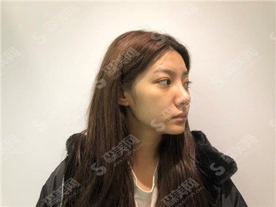 隆鼻整形价目表2021,假体隆鼻怎么样？内附假体隆鼻的1-7天真人恢复果图