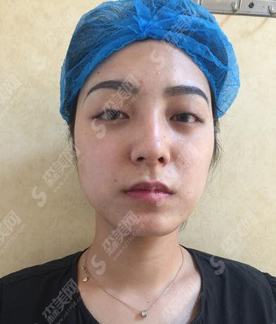 武汉天后整形医院价目表2021，内含割双眼皮的全部过程图