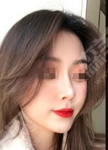 垫鼻子要多少钱？垫鼻子的果怎么样？附垫鼻子介绍及案例分享