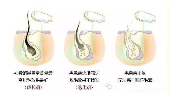 什么是激光脱毛?激光脱毛的注意事项及2021较新价目表