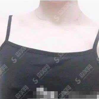 贾文整形医生隆胸做的技术怎么样?大同美神整形医院/口碑情况/案例展示