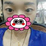 于智宏医生双眼皮整形做的可以吗?太原华美/简介/案例展示