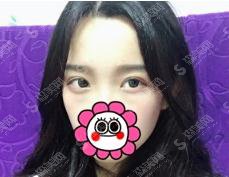 于智宏医生双眼皮整形做的可以吗?太原华美/简介/案例展示