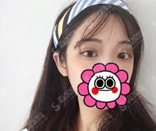 于智宏医生双眼皮整形做的可以吗?太原华美/简介/案例展示