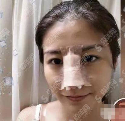 无锡人民医院美容科价目表2021,内含隆鼻整形恢复详情