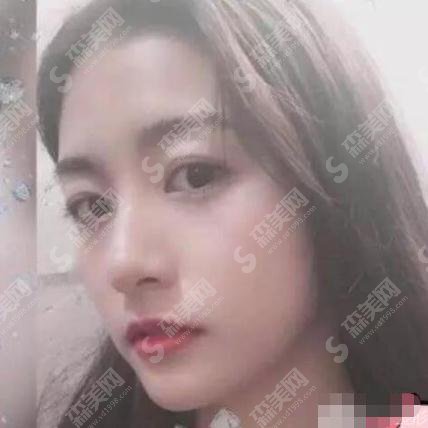 无锡人民医院美容科价目表2021,内含隆鼻整形恢复详情