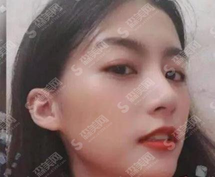 无锡人民医院美容科价目表2021,内含隆鼻整形恢复详情