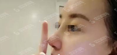 李清法整形医生隆鼻技术好吗?西安艺星整形/口碑情况/隆鼻案例