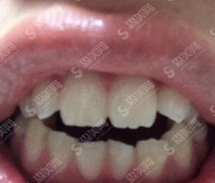 上海九院牙齿贴面价格2021,内含牙齿贴面果图公布