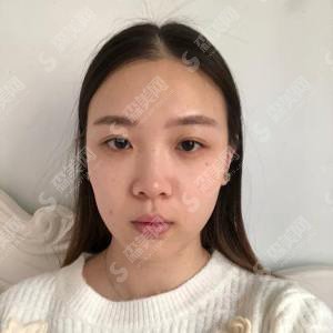 八大处靳小雷怎么样?靳小雷医生的技术实力盘点+瘦脸果展示