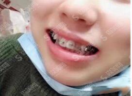 石家庄中诺口腔医院怎么样？石家庄中诺口腔的实力/石家庄中诺口腔的医生/牙齿矫正的整形果