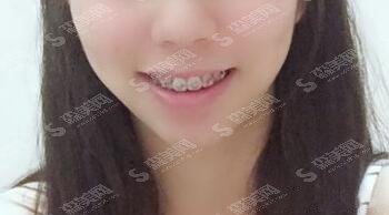 石家庄中诺口腔医院怎么样？石家庄中诺口腔的实力/石家庄中诺口腔的医生/牙齿矫正的整形果