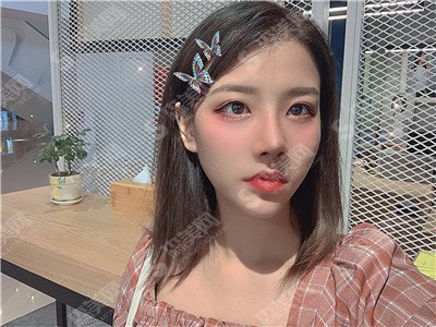 青岛大学附属医院的双眼皮手术价目表2021,全切双眼皮怎么样?内附双眼皮的手术果图