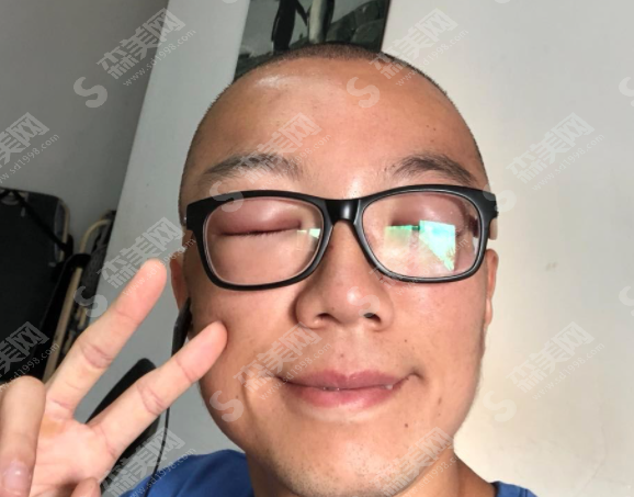 微创植发和有痕植发的区别是什么?植发的恢复果好吗?附植发案例分享