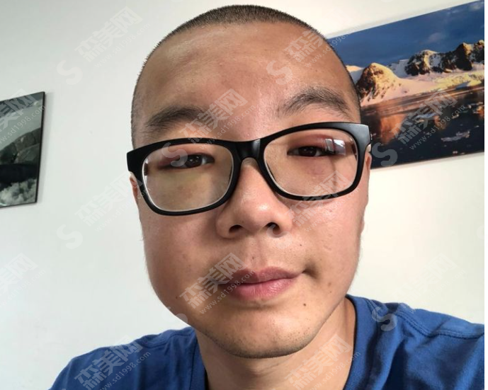 微创植发和有痕植发的区别是什么?植发的恢复果好吗?附植发案例分享