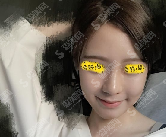 沈阳杏林整形美容医院做的膨体隆鼻果怎么样?附医生介绍/案例分享/2021较新价目表