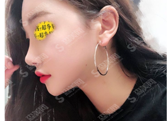 沈阳杏林整形美容医院做的膨体隆鼻果怎么样?附医生介绍/案例分享/2021较新价目表