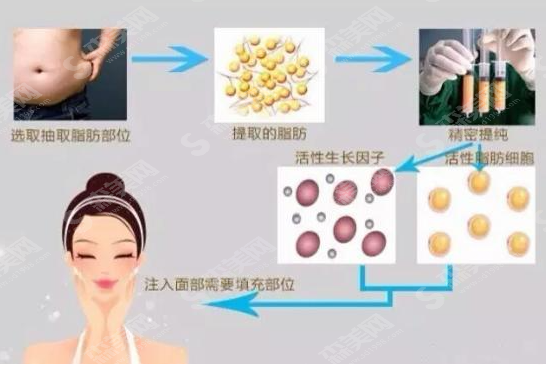 什么是自体脂肪填充?自体脂肪填充的优势及果介绍/2021较新价目表