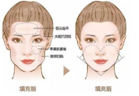 什么是自体脂肪填充?自体脂肪填充的优势及果介绍/2021较新价目表