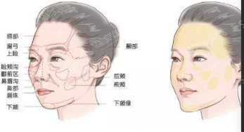 什么是自体脂肪填充?自体脂肪填充的优势及果介绍/2021较新价目表
