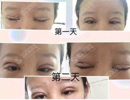 北京八大处靳小雷医生做的双眼皮果怎么样?医生介绍/案例分享/价目表2021