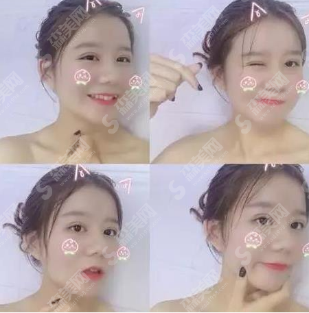 北京八大处靳小雷医生做的双眼皮果怎么样?医生介绍/案例分享/价目表2021