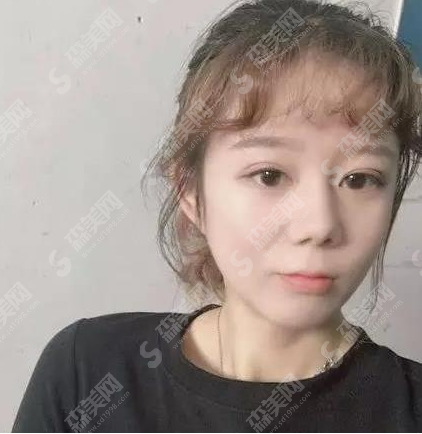 北京八大处靳小雷医生做的双眼皮果怎么样?医生介绍/案例分享/价目表2021