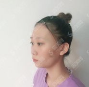 交大一附院收费价目表2021，内含彩光嫩肤术恢复果展示