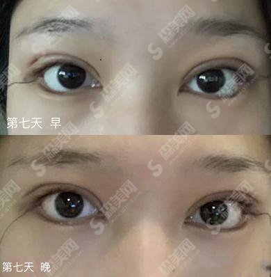 大连医大一院双眼皮做的怎么样呢?2021价目表公布+双眼皮整形案例分享