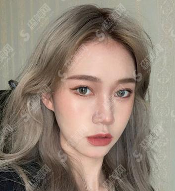 大连医大一院双眼皮做的怎么样呢?2021价目表公布+双眼皮整形案例分享