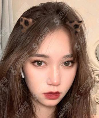 大连医大一院双眼皮做的怎么样呢?2021价目表公布+双眼皮整形案例分享