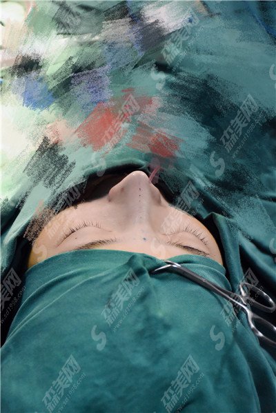 隆鼻整形手术价目表2021,肋软骨隆鼻整形怎么样?肋软骨隆鼻的术后果好不好