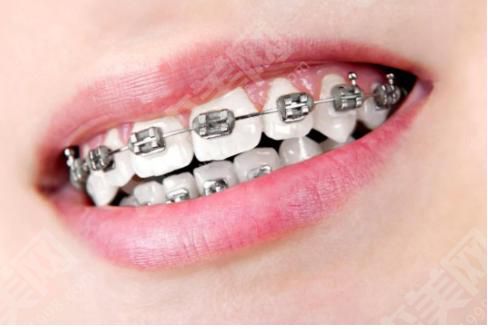 牙套的价格是多少？牙齿矫正的果如何？附带牙套的注意事项及案例分享