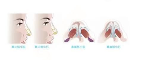 鼻翼缩小是什么？鼻翼缩小的果怎么样？附鼻翼缩小的价格以及案例