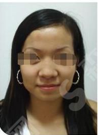鼻翼缩小是什么？鼻翼缩小的果怎么样？附鼻翼缩小的价格以及案例