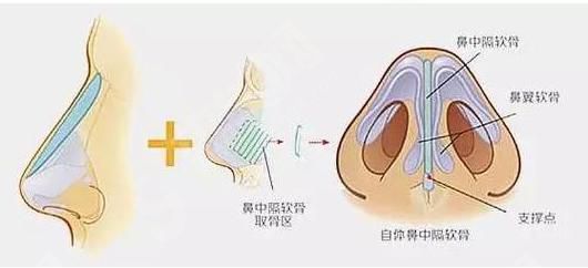 鼻小柱延长的原理,鼻小柱的果如何？附注意事项以及案例分享