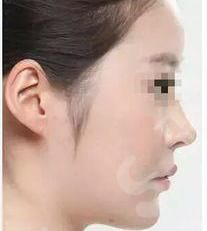 鼻小柱延长的原理,鼻小柱的果如何？附注意事项以及案例分享
