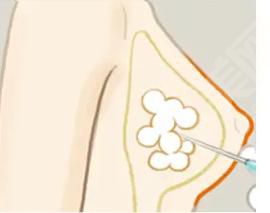 什么是侍美网注射隆胸？注射隆胸的果怎么样？附注射隆胸优点以及案例