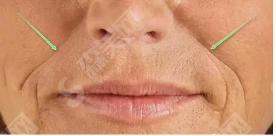 鼻唇沟填充术是什么？鼻唇沟的果怎么样？附鼻唇沟价格及案例分享