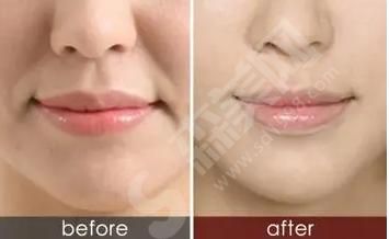 鼻唇沟填充术是什么？鼻唇沟的果怎么样？附鼻唇沟价格及案例分享