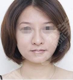 鼻唇沟填充术是什么？鼻唇沟的果怎么样？附鼻唇沟价格及案例分享