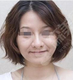 鼻唇沟填充术是什么？鼻唇沟的果怎么样？附鼻唇沟价格及案例分享