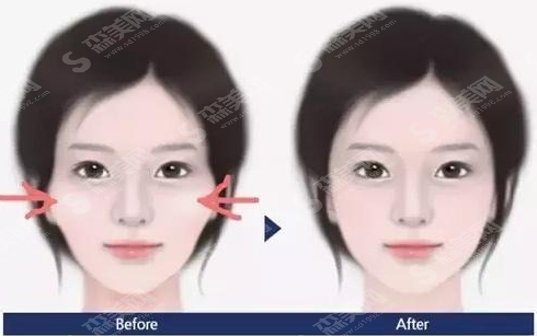 颧骨内推的术后果好吗?附颧骨内推案例分享及术后恢复果/2021较新价目表