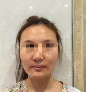 颧骨内推的术后果好吗?附颧骨内推案例分享及术后恢复果/2021较新价目表