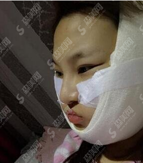 颧骨内推的术后果好吗?附颧骨内推案例分享及术后恢复果/2021较新价目表