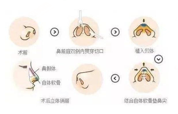 鼻部整形较新价目表2021,隆鼻的材料有哪些?肋软骨隆鼻案例分享